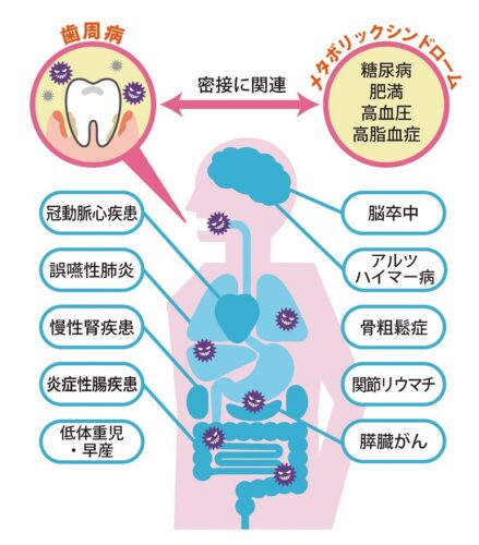 歯周病と全身疾患との関連